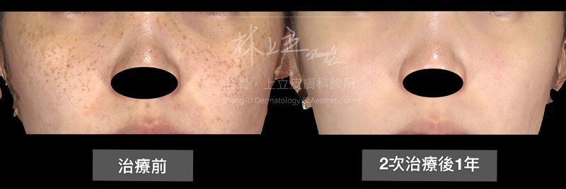 PicoSure755蜂巢皮秒雷射去除雀斑之後，膚色不均的狀況獲得改善，追蹤術後1年的可見狀況良好，並沒有新的斑點