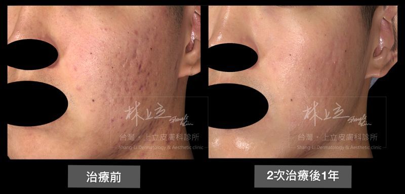 對於臉頰的痘疤凹疤，經過能像的調整後，改善的幅度也是肉眼可見的明顯