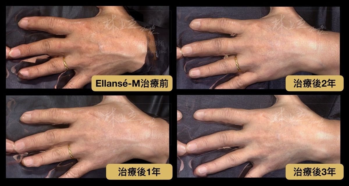 ELLANS&Eacute;洢蓮絲M劑型可以持續刺激皮膚的膠原蛋白，改善雞爪手