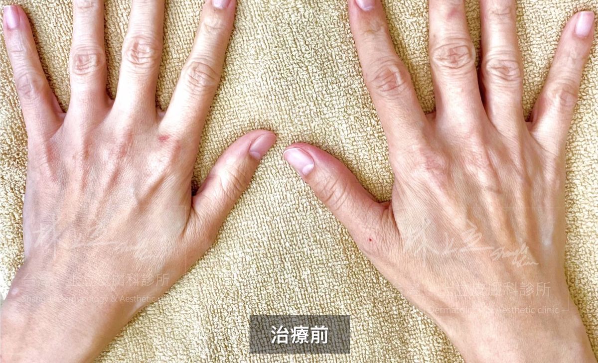 ELLANS&Eacute;洢蓮絲治療前的雞爪手