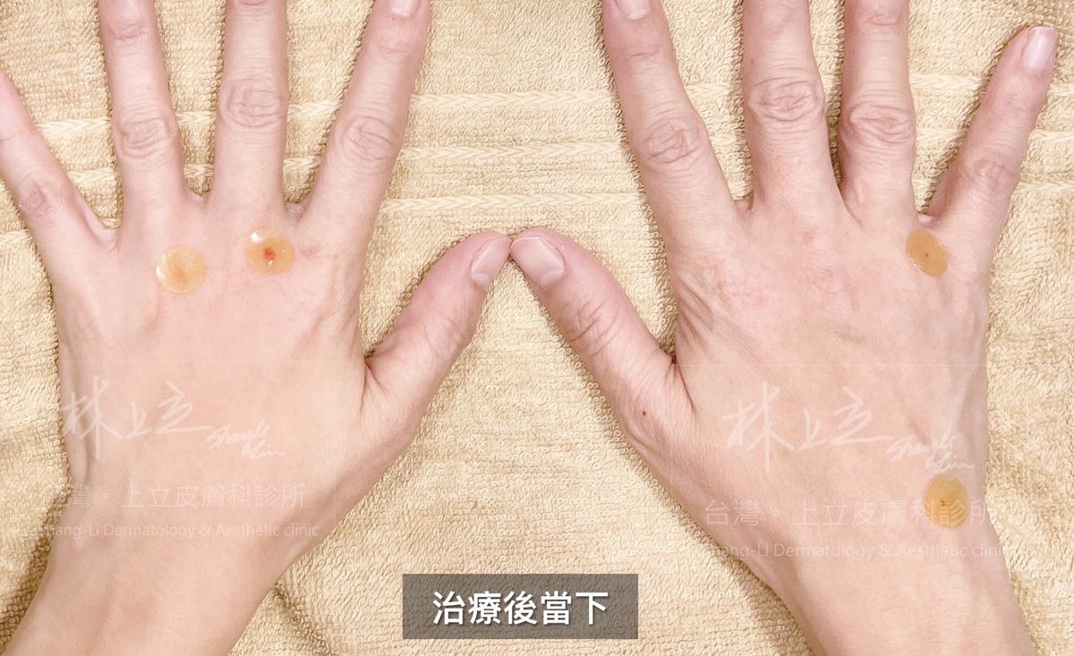 ELLANS&Eacute;洢蓮絲治療後，雞爪手改善