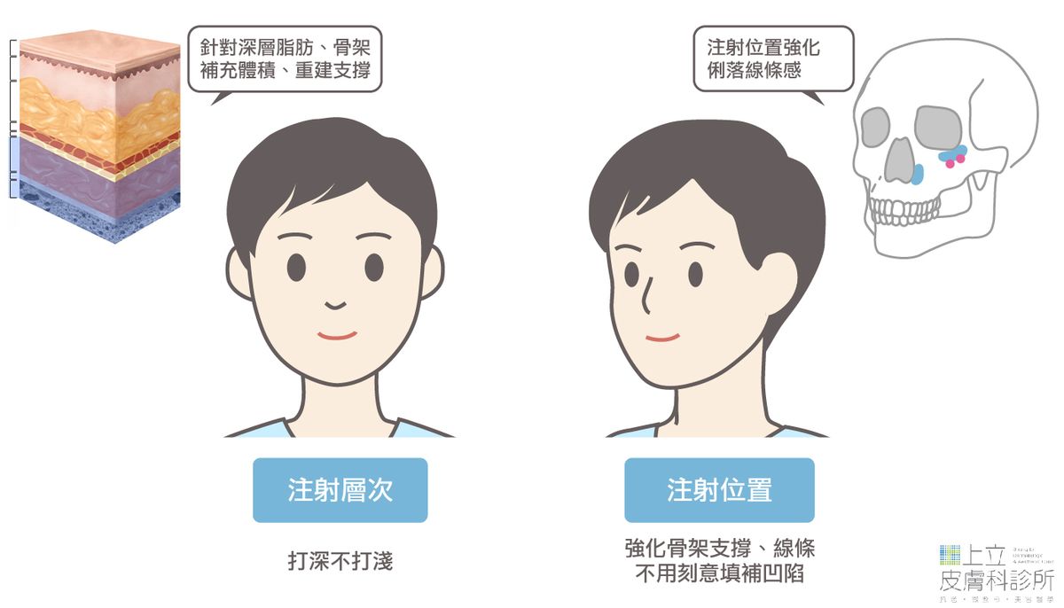 男性微整形注射層次和注射位置