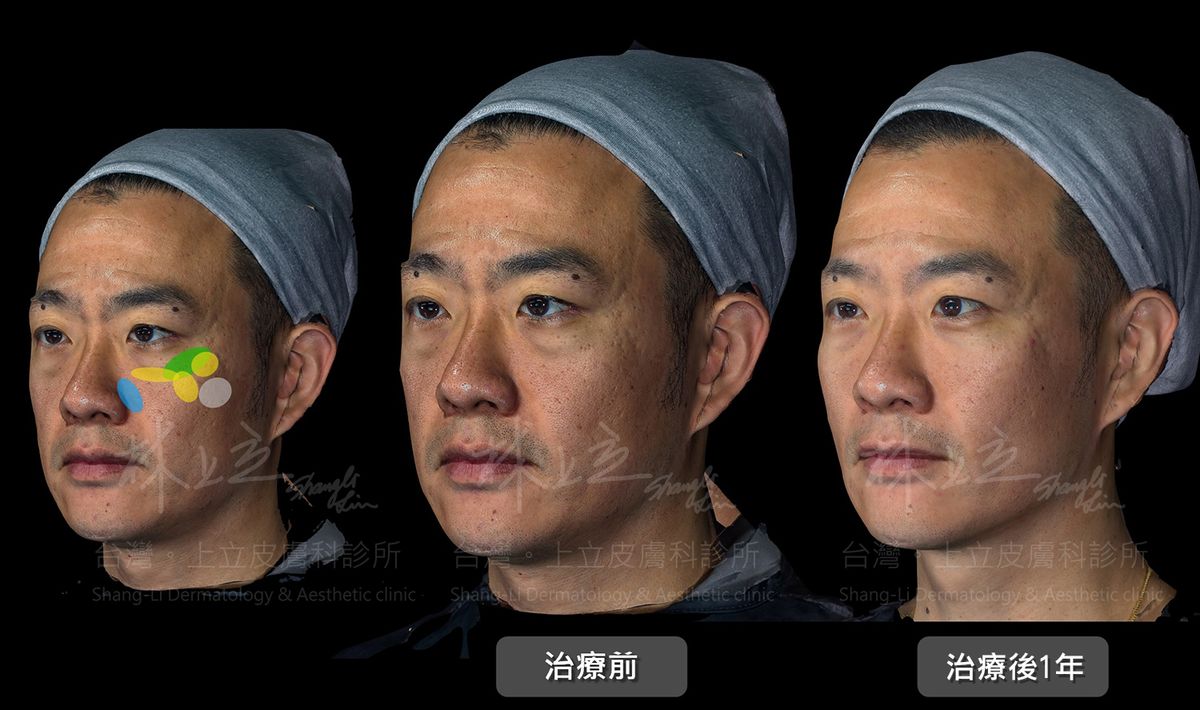 淚溝、眼袋是許多熟齡男性微整形會在意的問題