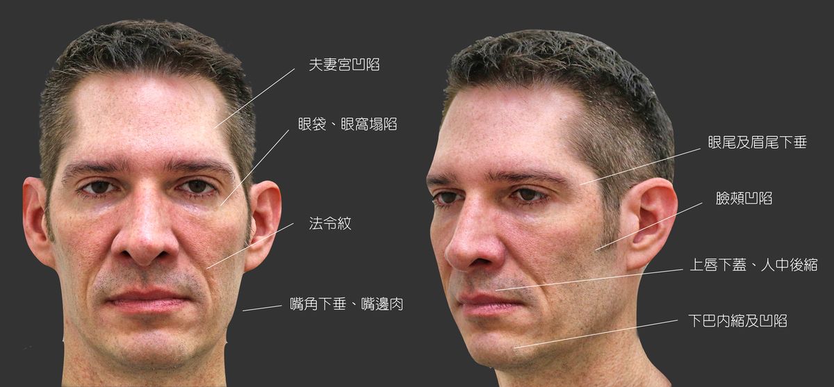 恢復皮膚的澎潤度，同時保有男性輪廓、線條的特徵，也會是治療重點。