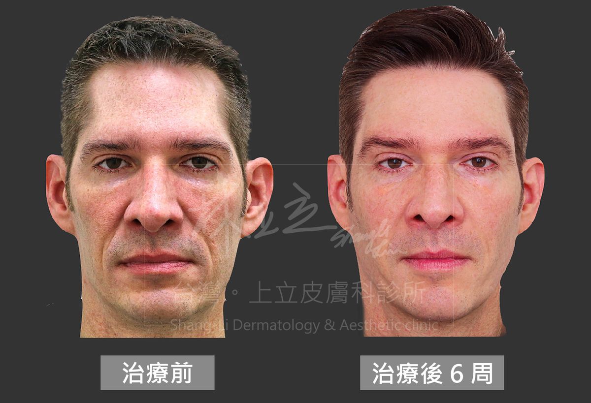 原先的疲憊和老態感消失，男性整個人看起來年輕、精神許多。