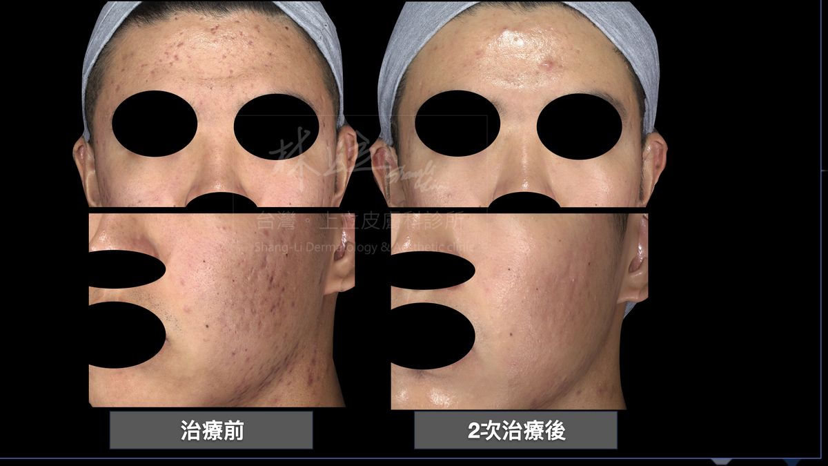 林上立醫師以Stellar心動光經過2次的治療，觀察到紅色痘痘減少許多