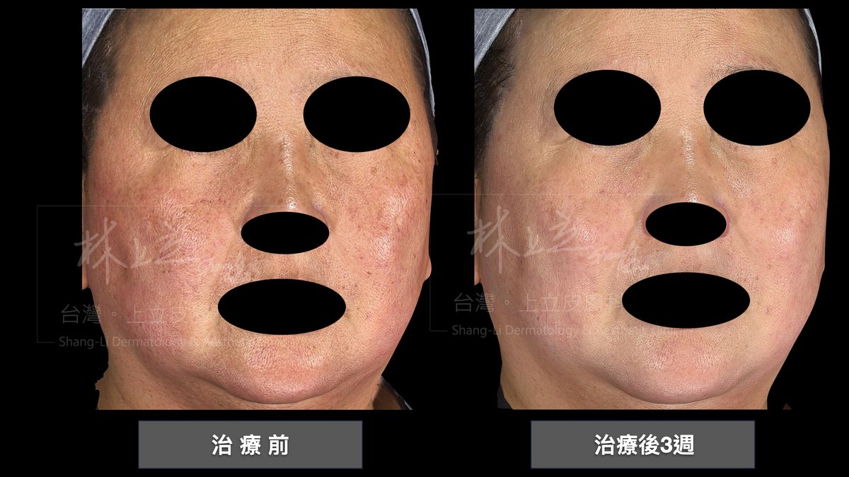 Stellar心動光（M22彩衝光）針對退紅有非常不錯的效果