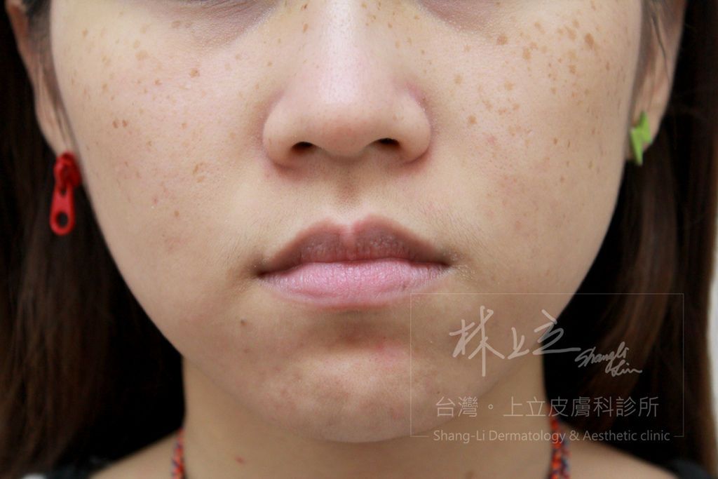 Elena除了雀斑之外，還有膚色黯沉、毛孔粗大的問題都有待解決。