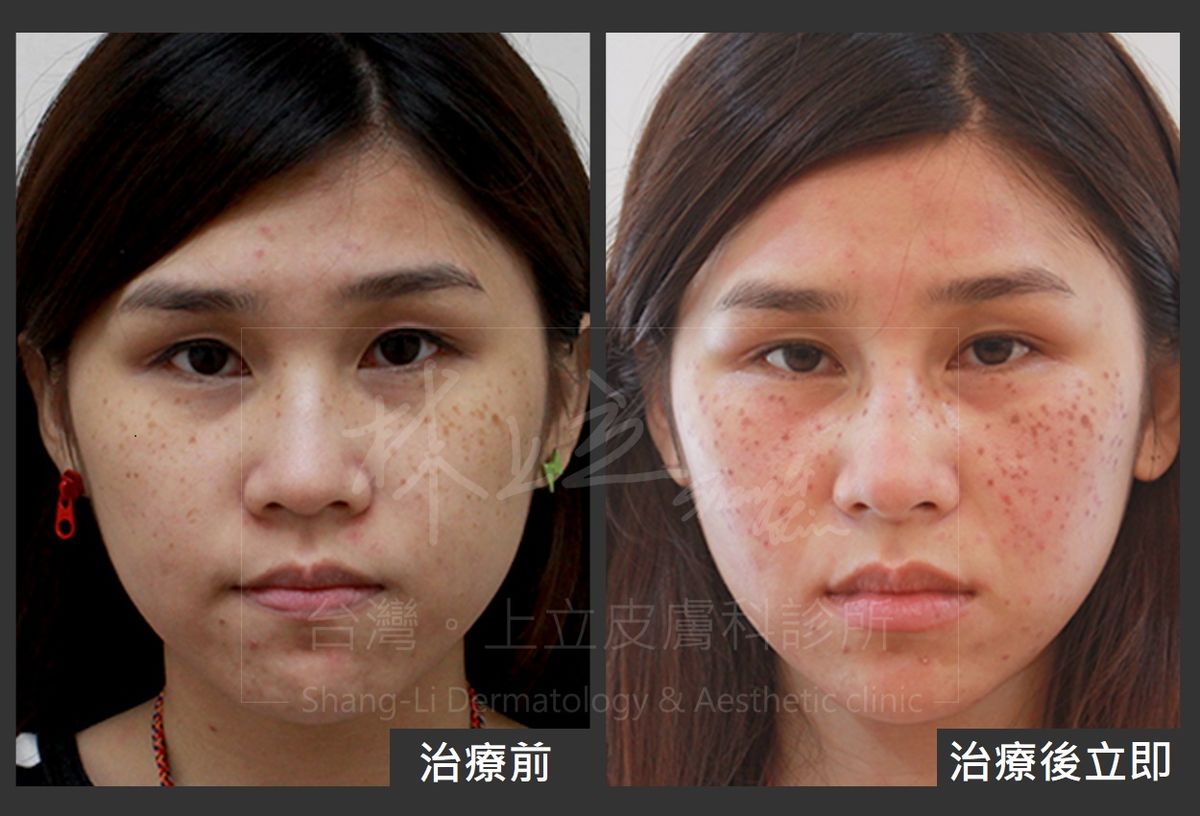 Elena利用PicoSure755蜂巢皮秒雷射進行一次治療之後，不只是消除了雀斑