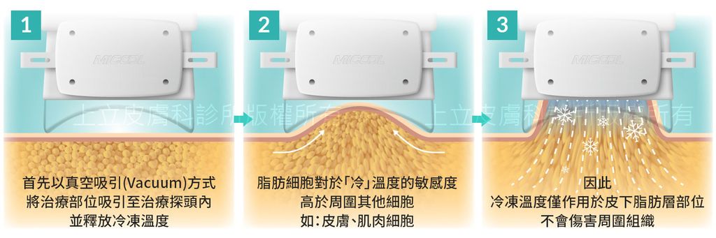 冷凍減脂是以低溫（-10℃）冷凍溫度原理