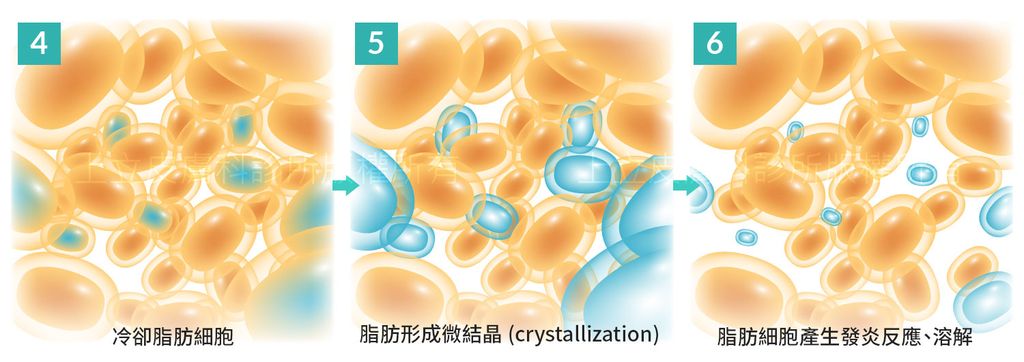 冷凍減脂作用於脂肪細胞，促使脂肪細胞自然凋亡後