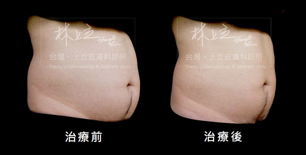 冷凍溶脂則可以輔助減少肚子的脂肪。