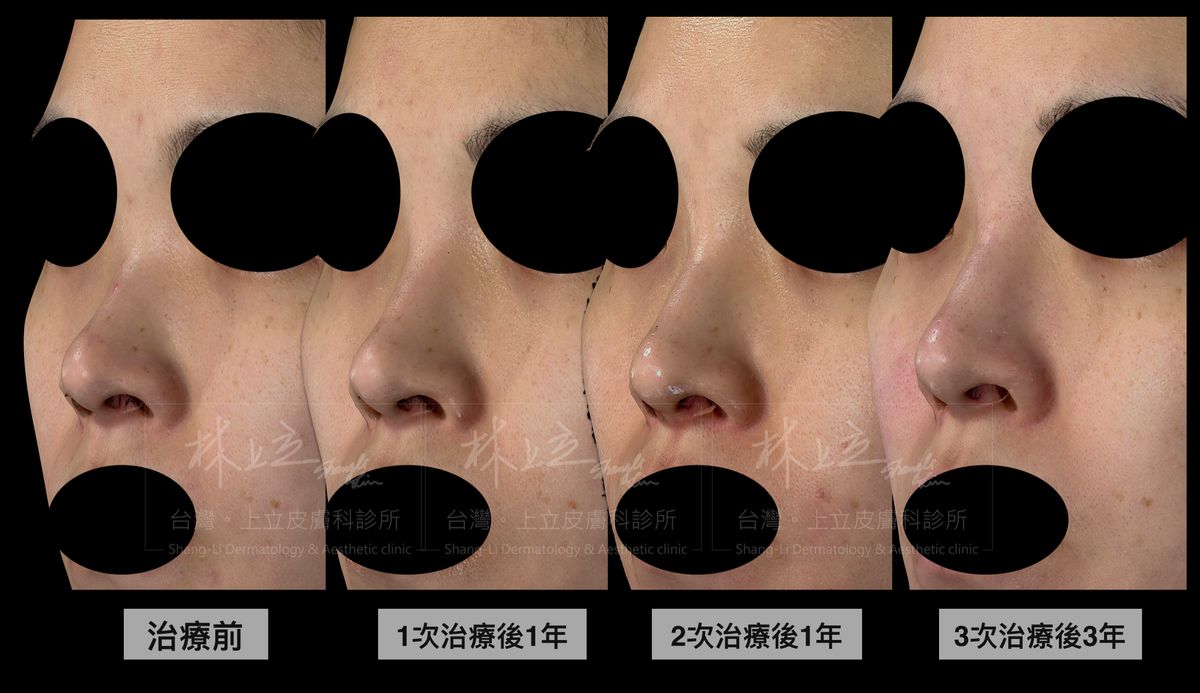 完全沒有洢蓮絲治療前，鼻子的山根比較扁塌、鼻樑單薄沒有肉
