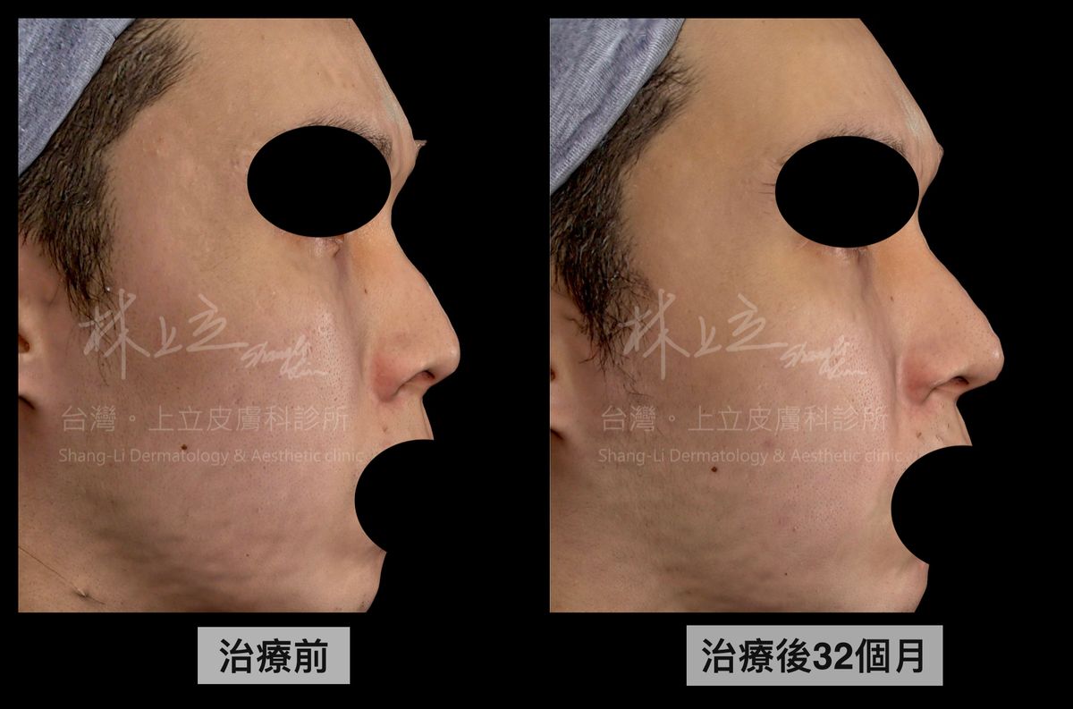 採取ELLANS&Eacute;洢蓮絲讓鼻背線條挺直流暢