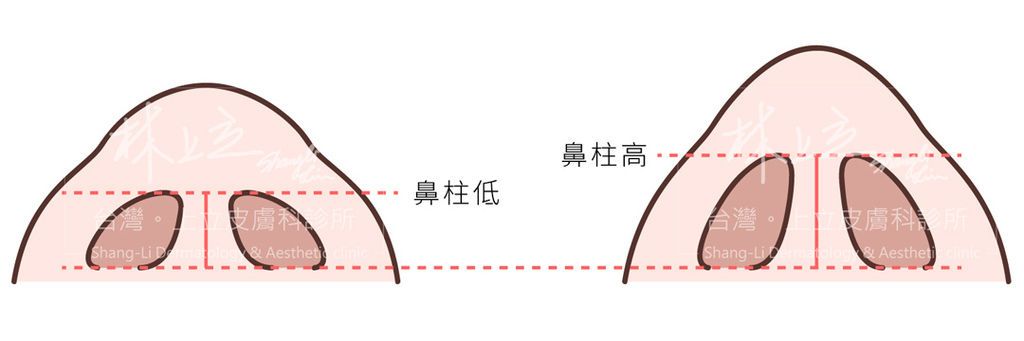 鼻柱高低對於鼻型也有一定程度的影響。