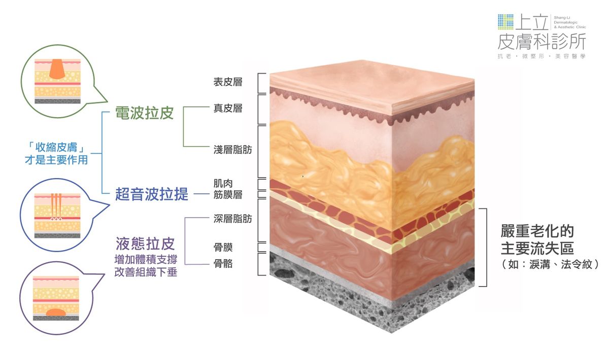 電波拉皮的作用部位只集中在真皮層和軟組織，主要作用就是收縮皮膚