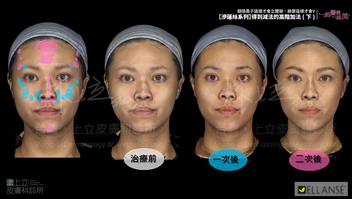 林上立醫師建議將治療分為透過二次階段洢蓮絲治療
