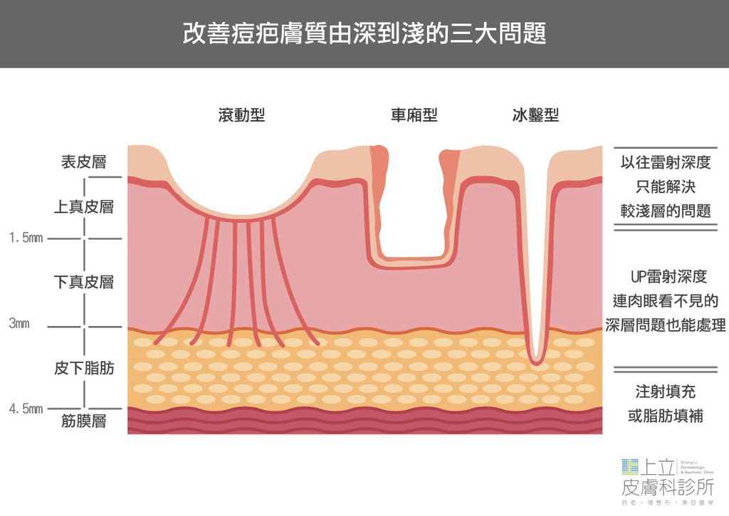 改善痘疤膚質由深到淺的三大問題，UP雷射可協助改善痘疤