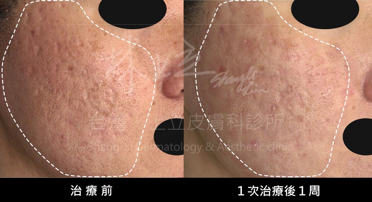 UP雷射大幅縮短了治療痘疤術後修復期的時間