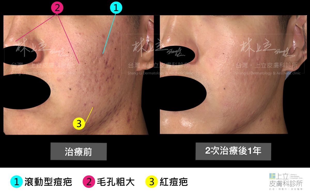 皮秒雷射對於滾動型痘疤、紅痘疤都有很不錯的改善效果。