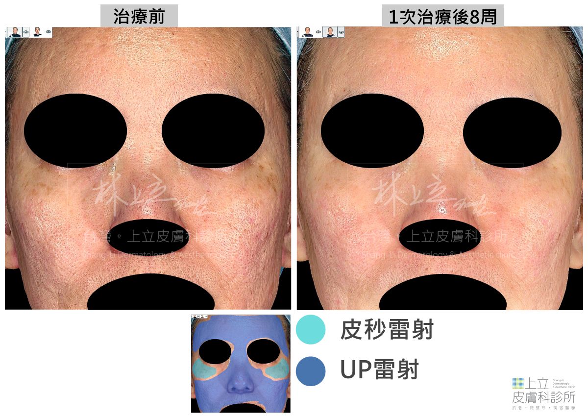 林上立醫師將合併這UP雷射和皮秒雷射一起治療，創造出更好的治療效果。