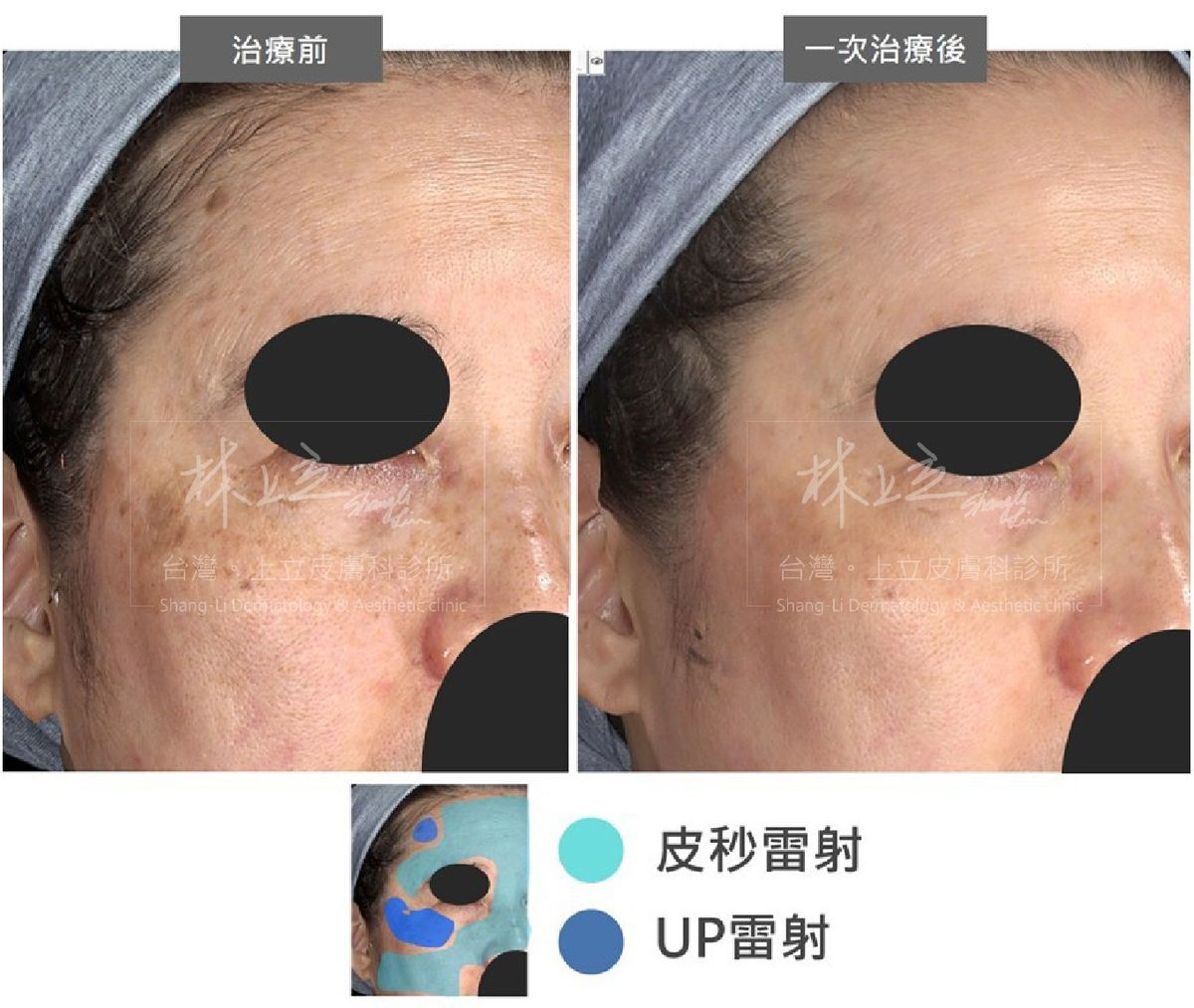 大面積的使用PicoSure755蜂巢皮秒雷射來治療，但在局部突起的老人斑上，則使用UP雷射來治療
