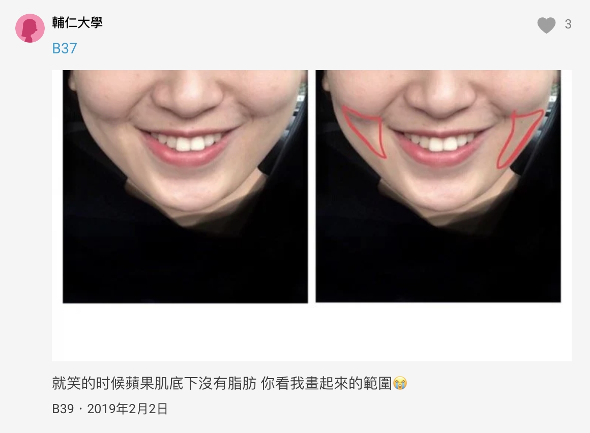 打完消脂針之後，雖然臉頰變瘦了，嘴角處卻形成不自然的凹陷。
