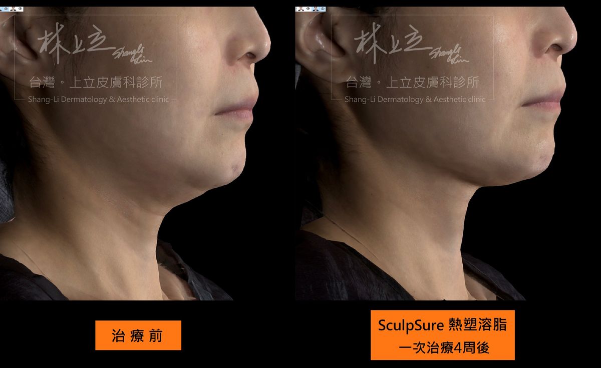 culpSure熱塑溶脂只要單次治療，就可以明顯減少雙下巴的脂肪