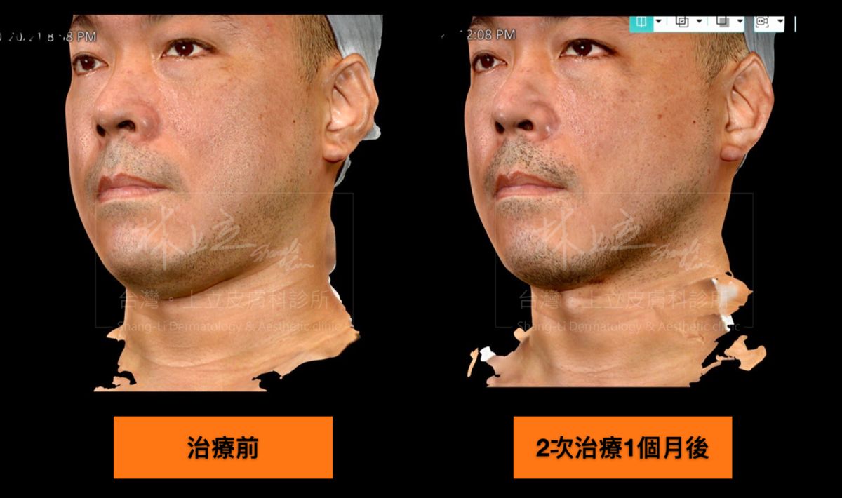 進行二次SculpSure熱塑溶脂的治療，雙下巴減脂效果更加顯著。