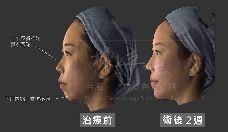 天生下巴後縮導致嘴巴凸凸，可以利用注射材質去增加下巴的骨架支撐，改善臉部比例不佳的問題