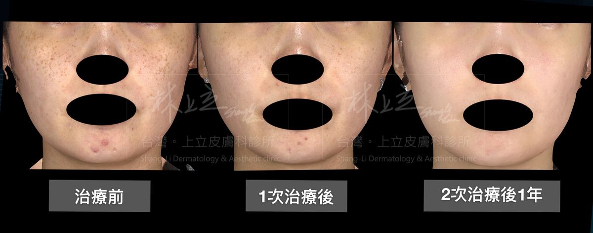 PicoSure755蜂巢皮秒雷射的２次治療之後，毛孔也更細緻，比起完全沒有治療之前好上很多。