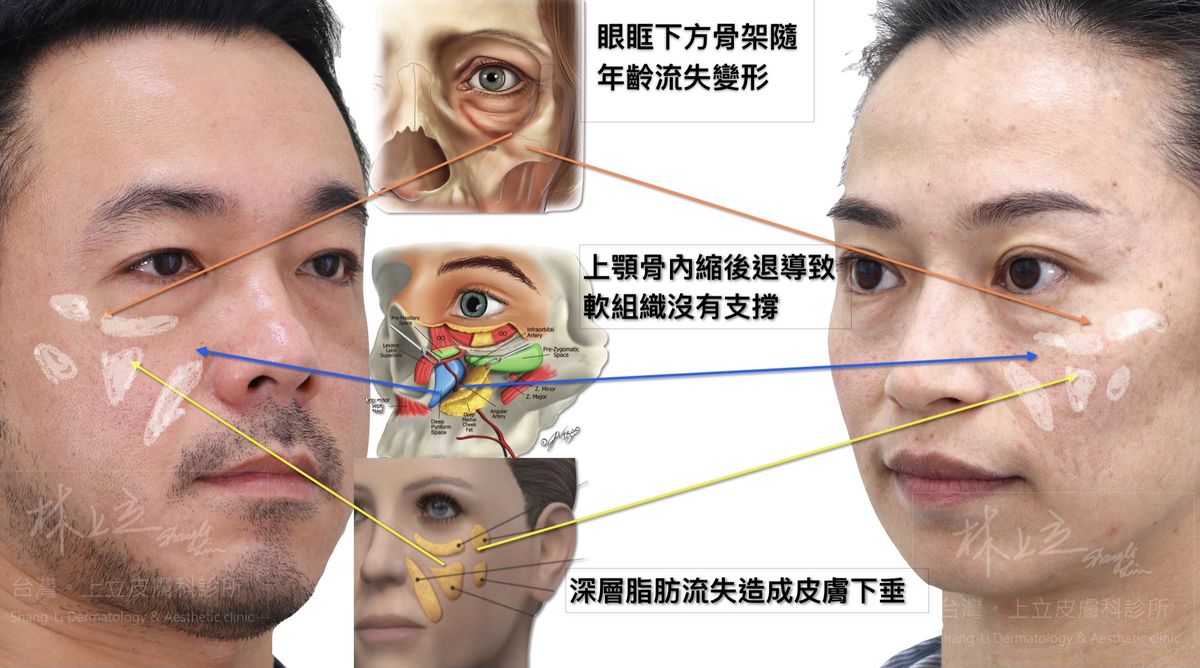 眼下和兩頰的軟組織失去支撐而往下滑，最終在眼睛下方形成凹陷溝紋。