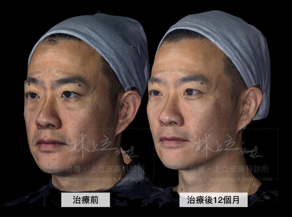 注射ELLANS&Eacute;洢蓮絲改善淚溝後的1年，可以發現不只淚溝的改善效果還是維持很好