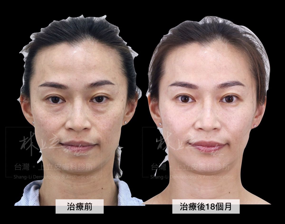 利用ELLANS&Eacute;洢蓮絲治療淚溝之後，臉也跟著拉提和變小了