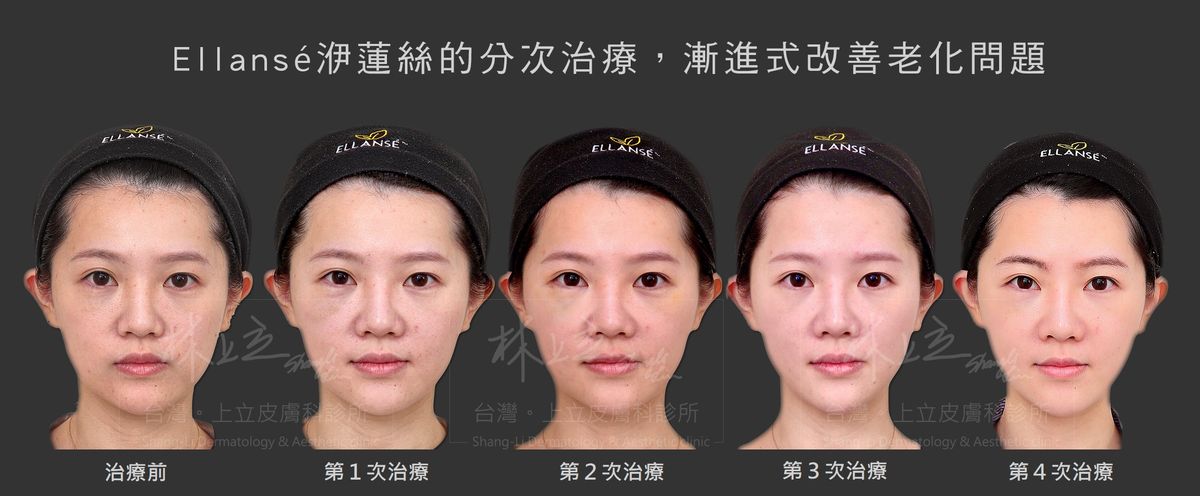 洢蓮絲循序漸進改善老化問題，即能降低單次治療成本