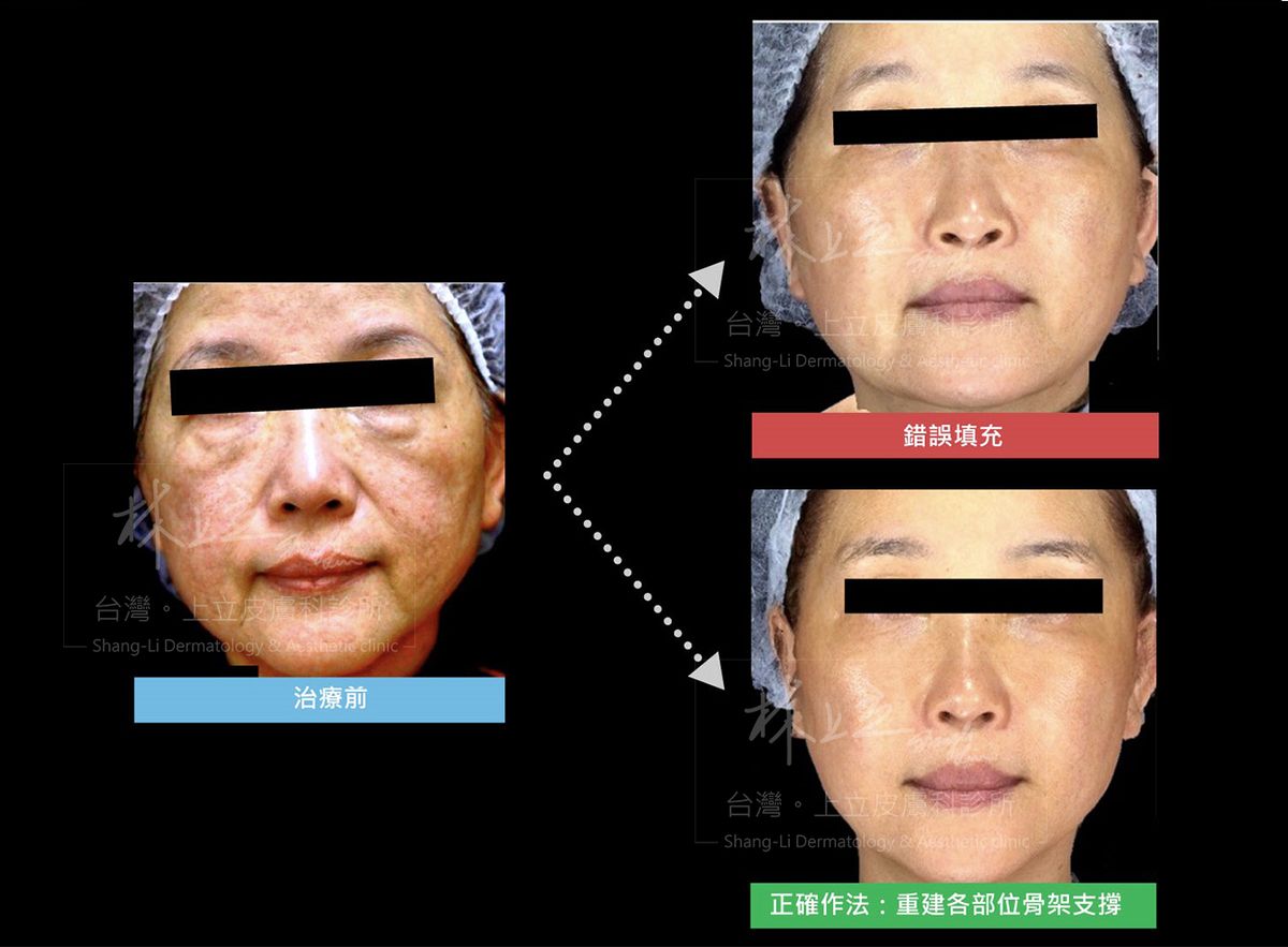 洢蓮絲施打的位置不正確、沒有準確的打在流失的位置及深度