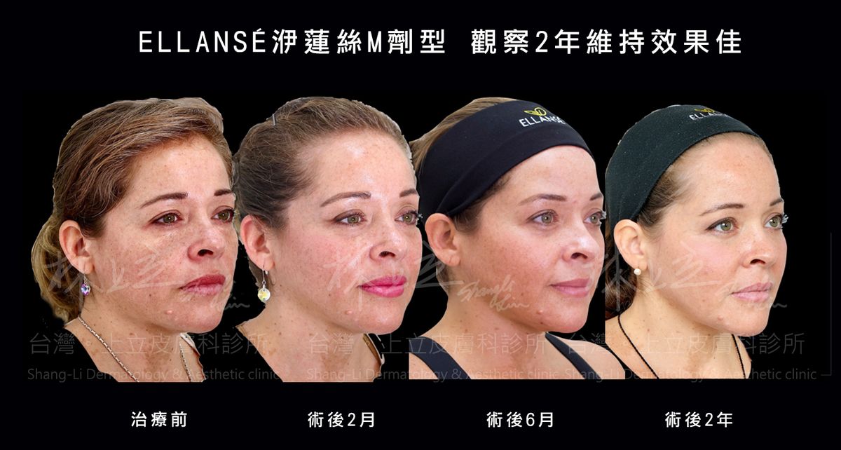 ELLANS&Eacute;洢蓮絲Ｍ劑型，觀察2年維持效果佳