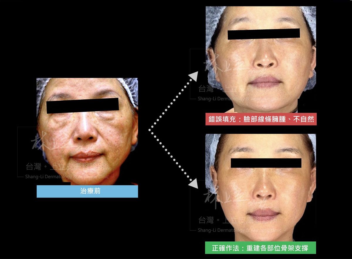 ELLANS&Eacute;洢蓮絲治療效果不佳如圖右上；其實只要將ELLANS&Eacute;洢蓮絲注射在正確的點位和深度上