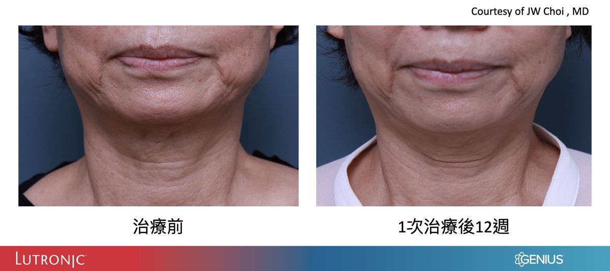 精靈電波治療頸紋案例前後比較