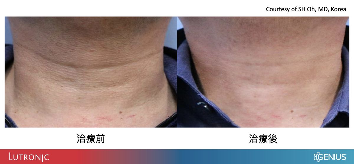 精靈電波治療頸紋案例前後比較