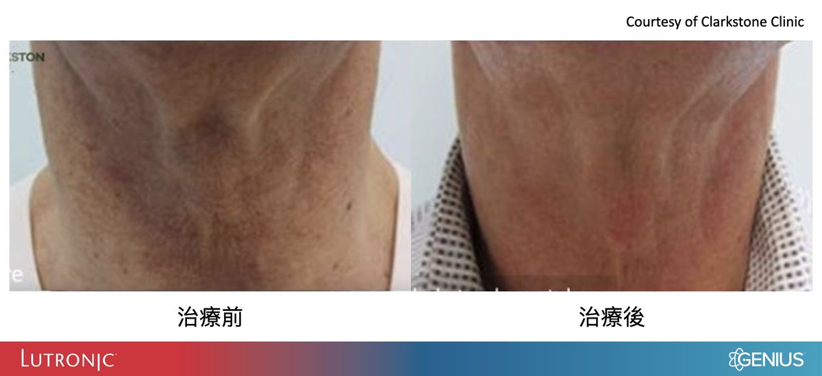 精靈電波治療頸紋案例前後比較