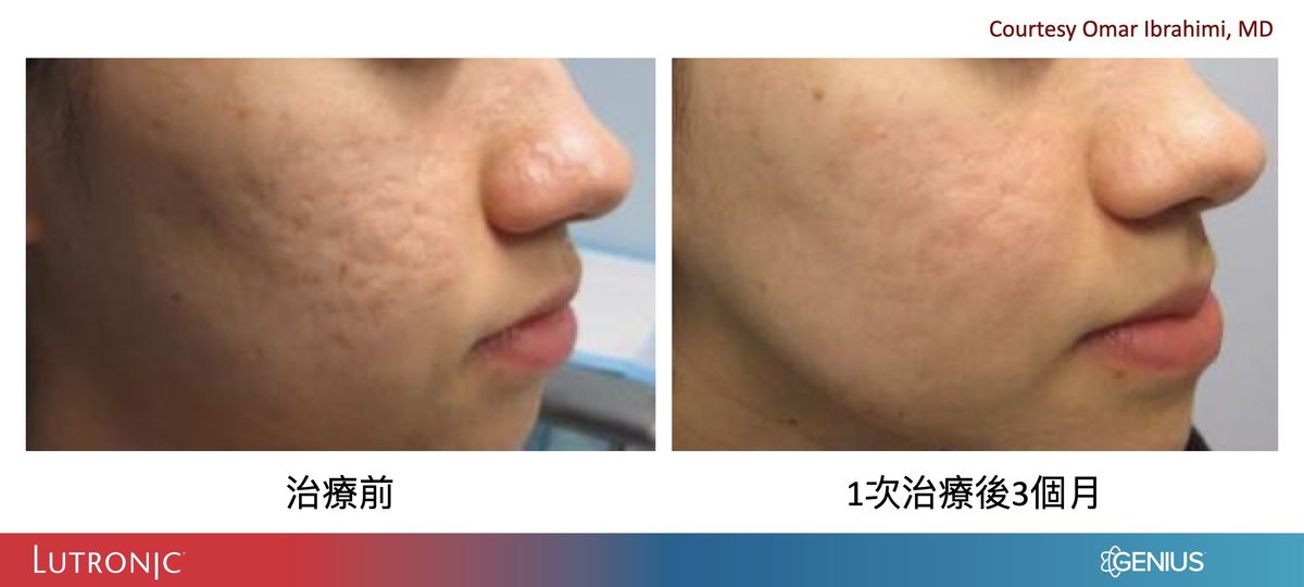 精靈電波治療痘疤凹疤案例前後比較