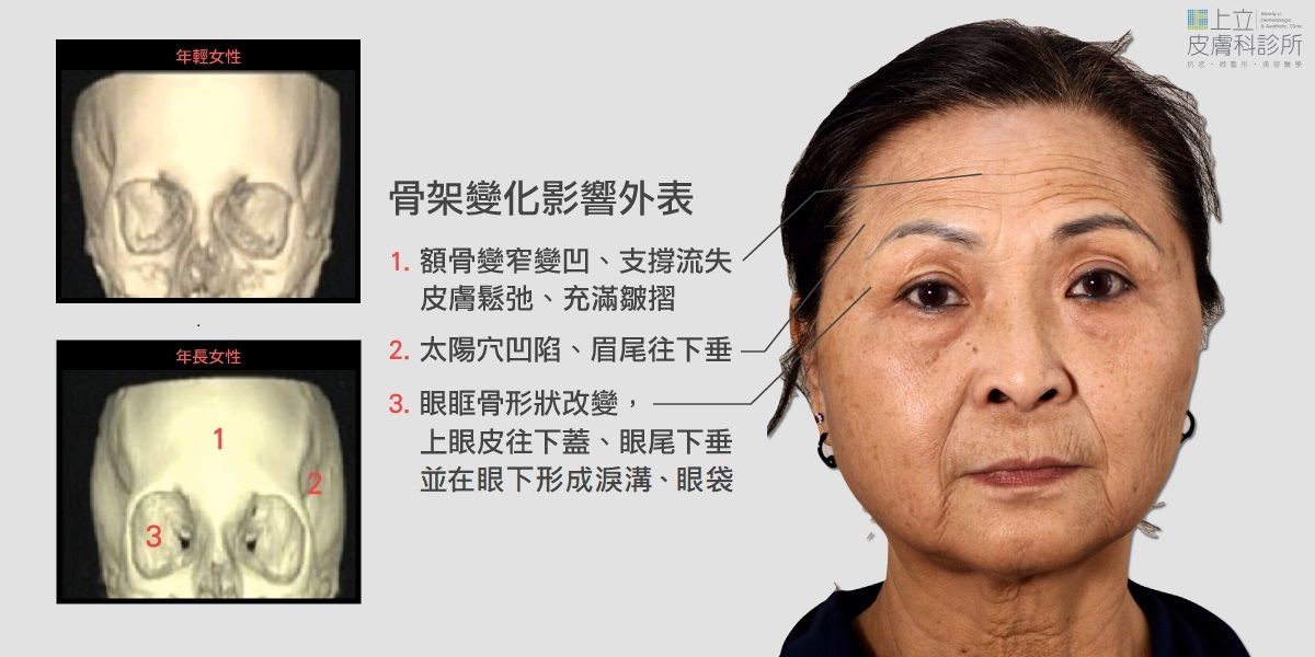 骨架變化影響外表，有淚溝、眼周細紋，想打ELLANS&Eacute;洢蓮絲改善淚溝。