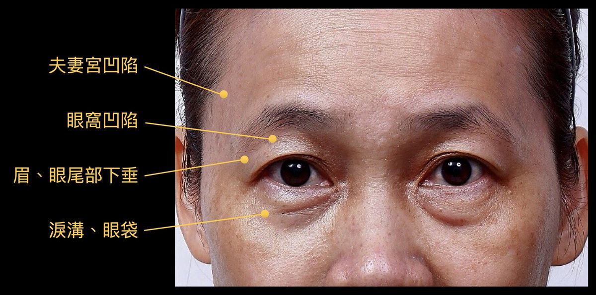 5大老化症狀，包括夫妻宮凹陷、眼窩凹陷、眉眼部下垂、淚溝、眼袋