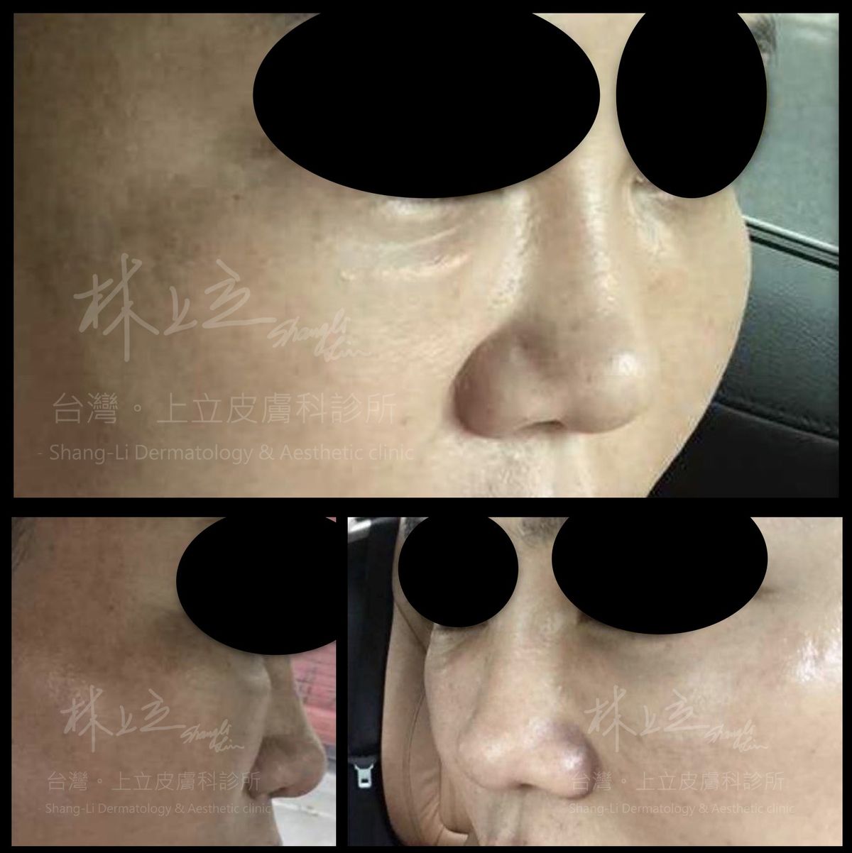 注射物不正確的填補在淚溝凹陷處，可能會造成眼下出現不自然的突起