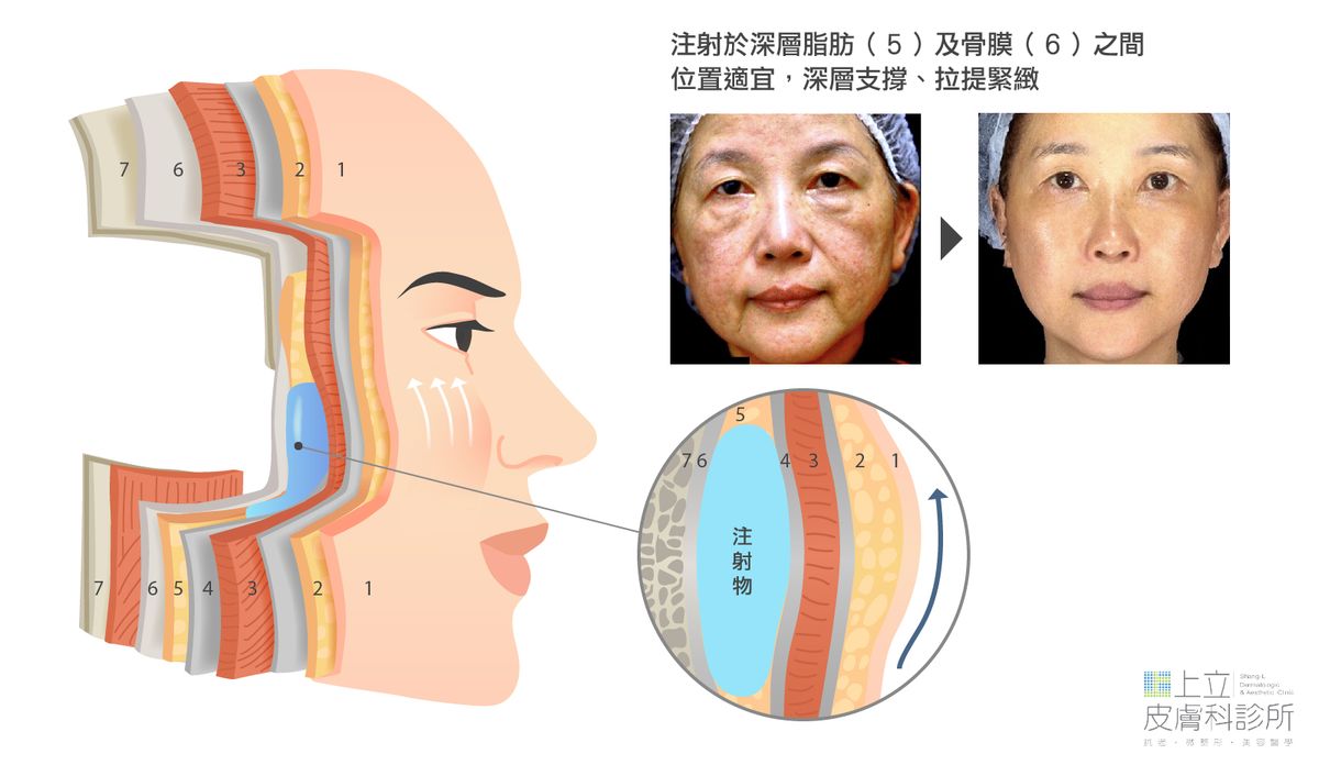 ELLANS&Eacute;洢蓮絲注射在眼框骨，提供眼周良好的體積支撐