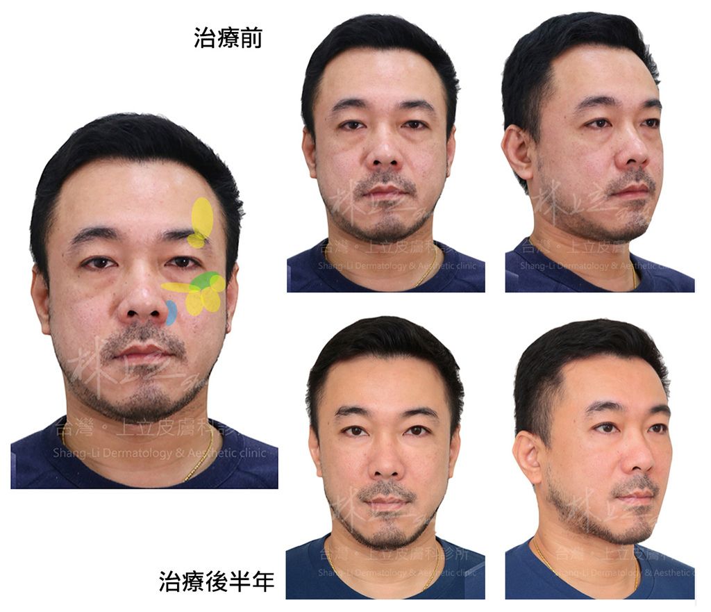ELLANS&Eacute;洢蓮絲男性患者案例1