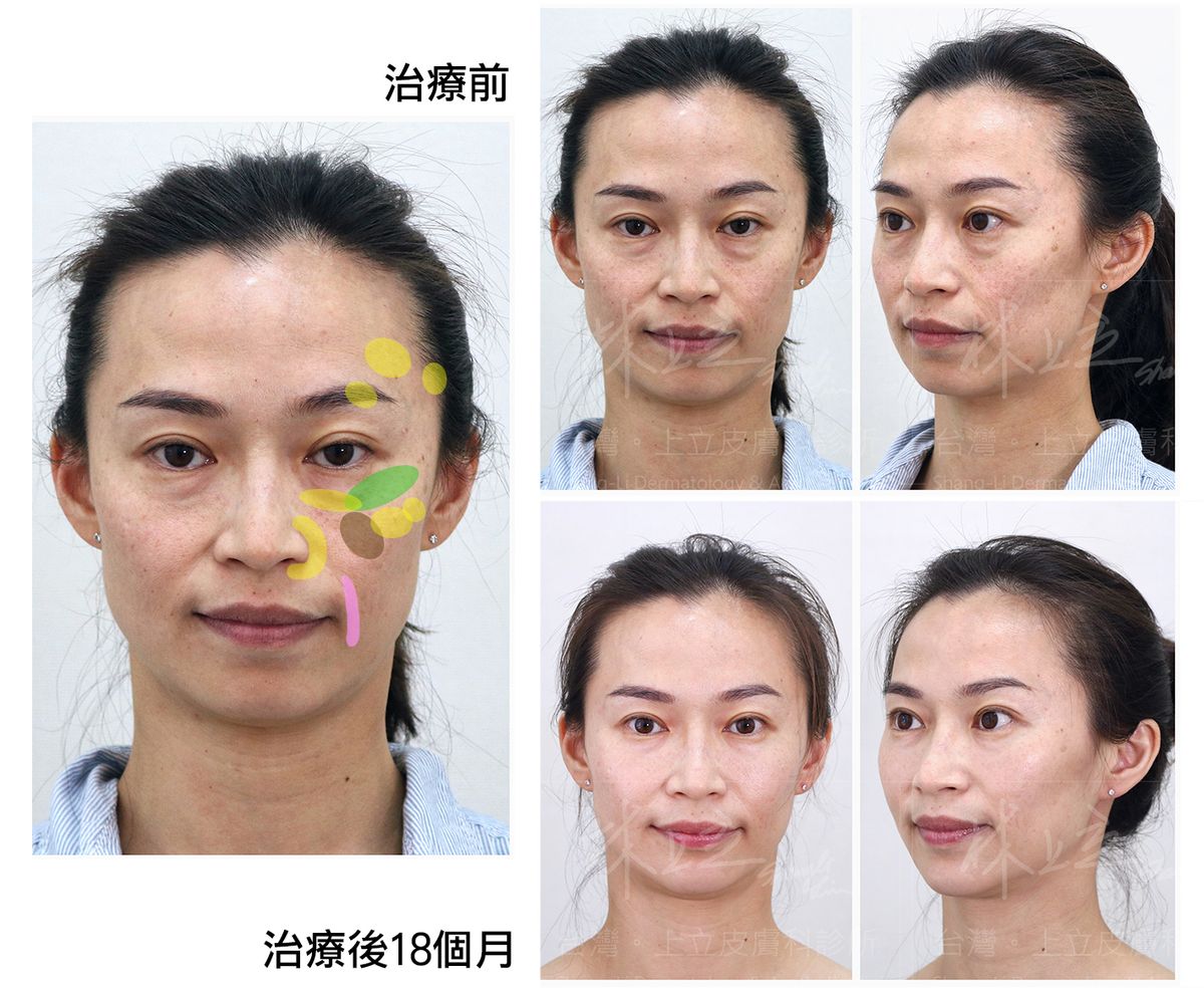 ELLANS&Eacute;洢蓮絲女性患者案例2