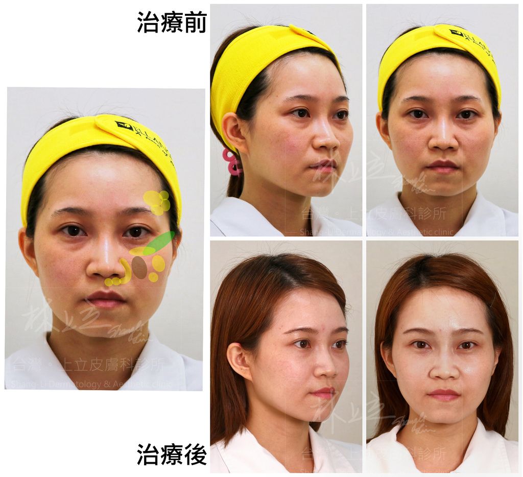 ELLANS&Eacute;洢蓮絲女性患者案例1