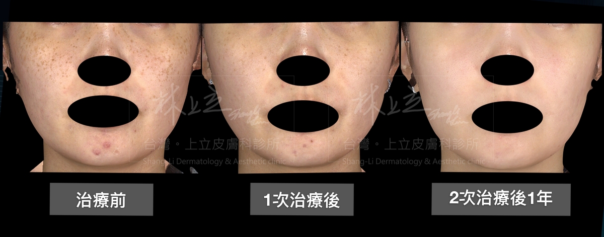 PicoSure755蜂巢皮秒雷射1次治療雀斑後都有5～6成左右的改善了